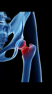 Hip fracture recovery